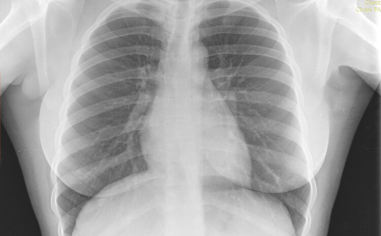  Principaux syndromes radiologiques du thorax